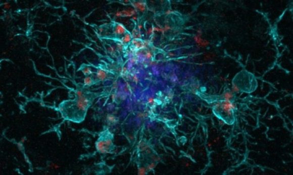Covid-19 pode acelerar doença de Alzheimer, revela novo estudo