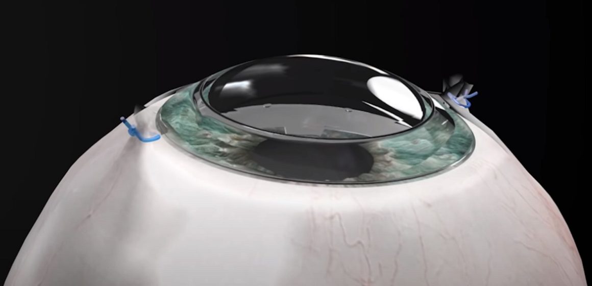 corneat-synthetic-cornea Córnea sintética que faz cegos recuperarem a visão é criada em Israel