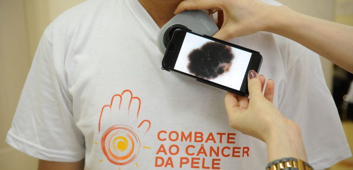 Em mais de seis meses, Pará registra quase 300 casos de câncer de pele