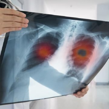 Primeiro autotransplante de pulmão em paciente com câncer no Brasil é realizado em São Paulo