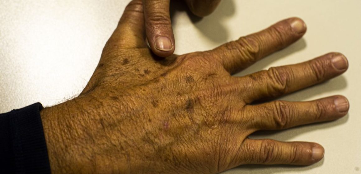 Tecnologia para tratar câncer de pele é aprovada para uso no SUS