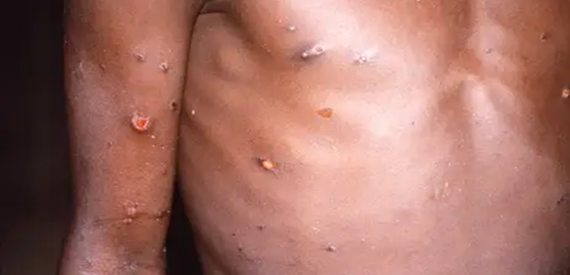 OMS faz recomendações temporárias para situações de surto por mpox