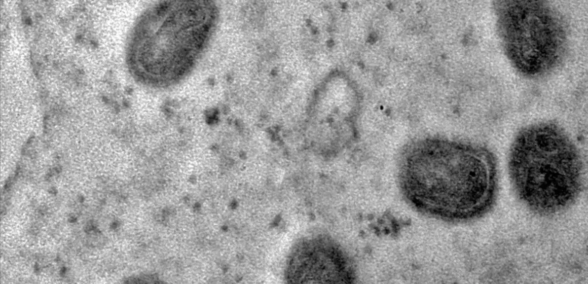 Surto de mpox na África preocupa OMS