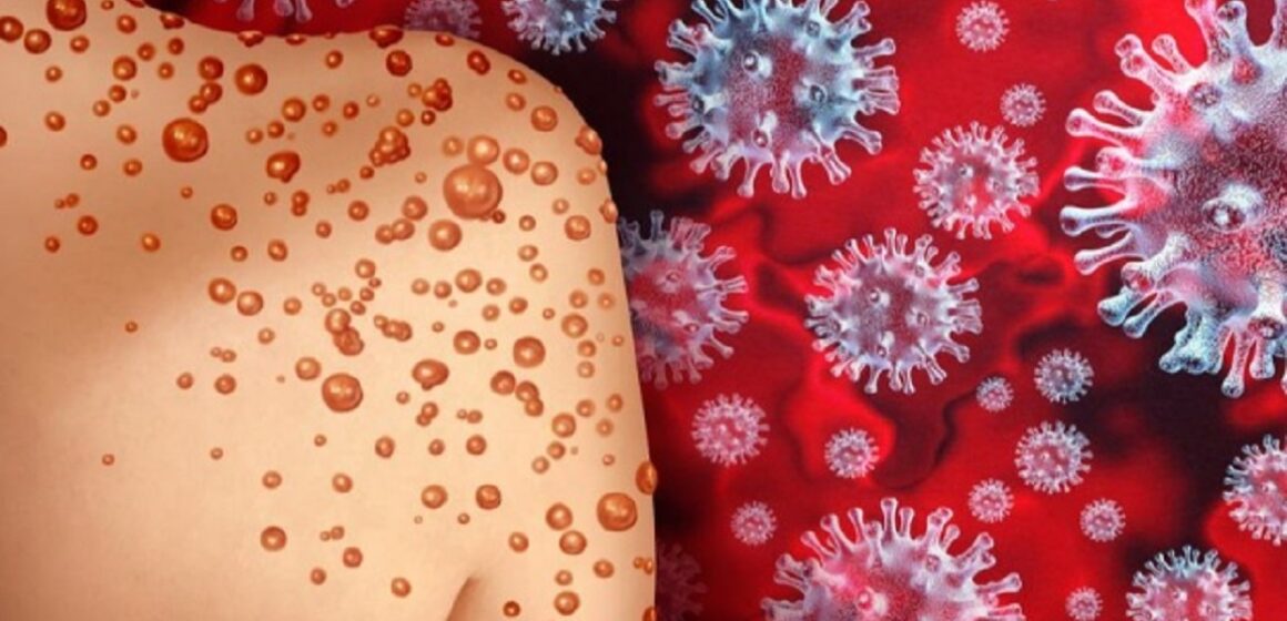 Pará já registrou 2 casos de Mpox este ano
