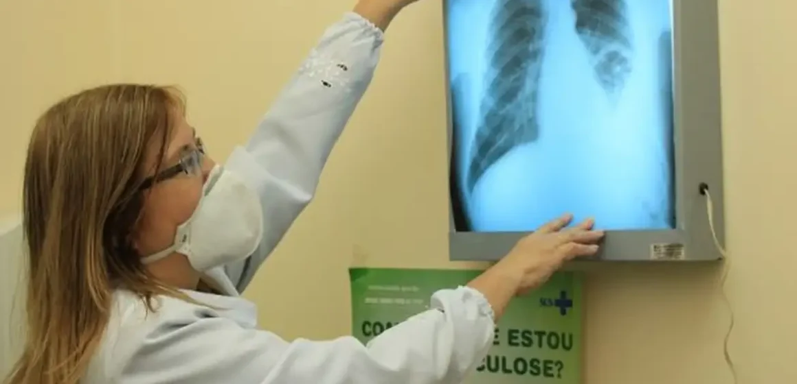 Baixo financiamento mundial ameaça combate à tuberculose