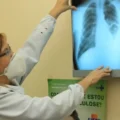 Baixo financiamento mundial ameaça combate à tuberculose