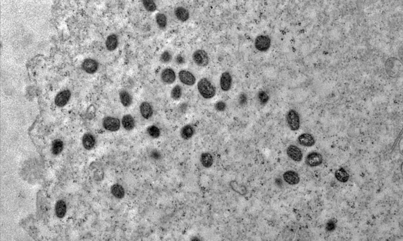 Região Norte do Brasil registra casos de mpox