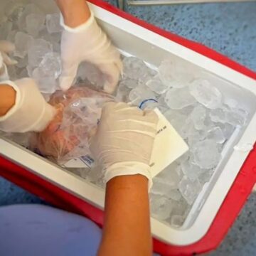Brasil bate recorde em transplantes, mas enfrenta queda de doadores e fila de espera de 78 mil