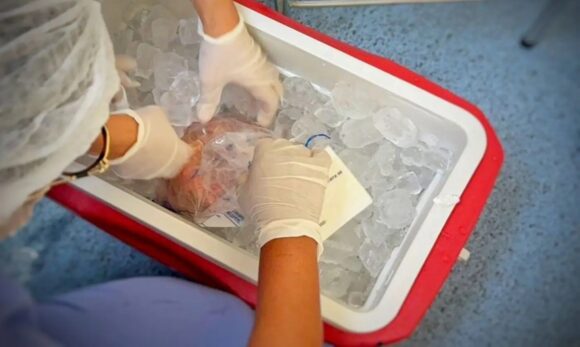 Brasil bate recorde em transplantes, mas enfrenta queda de doadores e fila de espera de 78 mil