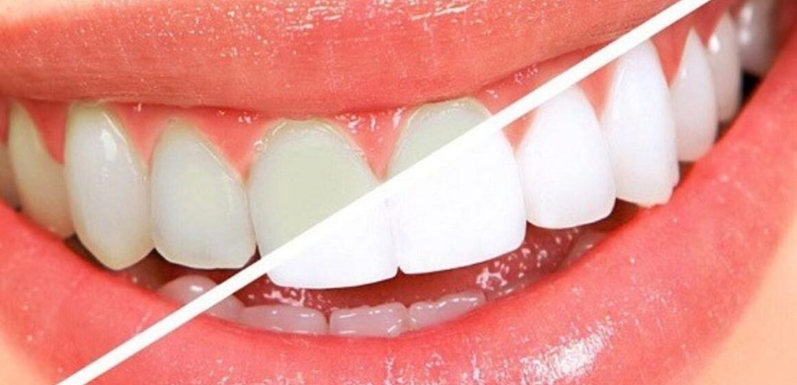 Brancorexia: a obsessão por dentes ultra-brancos que ameaça a saúde bucal