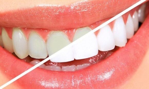 Brancorexia: a obsessão por dentes ultra-brancos que ameaça a saúde bucal