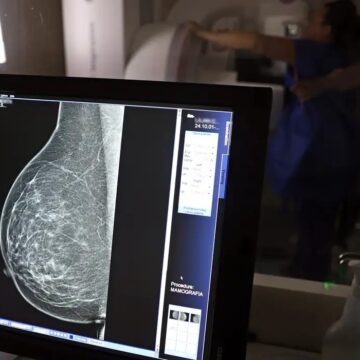 Câncer de mama atinge uma em cada três mulheres abaixo dos 50 anos no Brasil