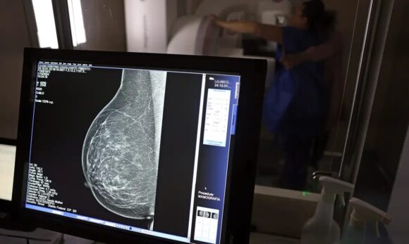 Câncer de mama atinge uma em cada três mulheres abaixo dos 50 anos no Brasil