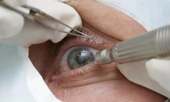 Cirurgia para mudar cor dos olhos é restrita a casos de cegueira, alertam oftalmologistas