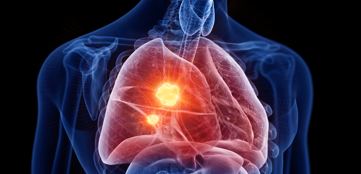 Câncer+de+pulmão+quando+a+cirurgia+é+o+melhor+tratamento BioNTech inicia testes clínicos da primeira vacina contra câncer de pulmão em sete países