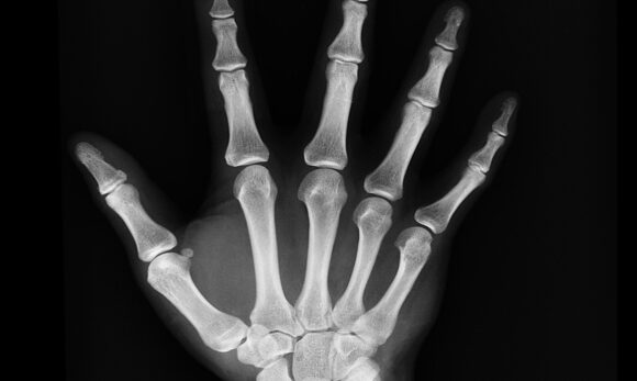hand-x-ray Pesquisadores chineses desenvolvem cola óssea que regenera fraturas em três minutos