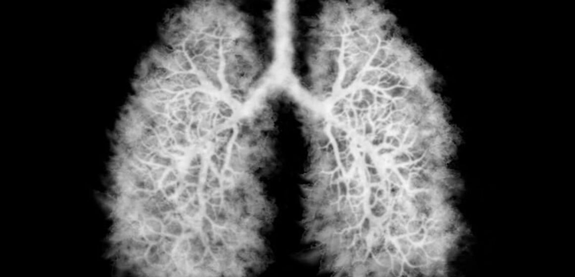 WhatsApp Image 2026-02-19 at 09.00.49 “Pulmão de pipoca”: doença grave associada ao vape causa danos irreversíveis e pode levar ao transplante