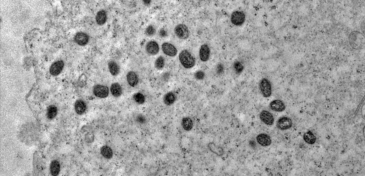 monkeypox_02 Brasil registra 55 casos de mpox em 2026 e acende alerta para nova variante identificada no exterior
