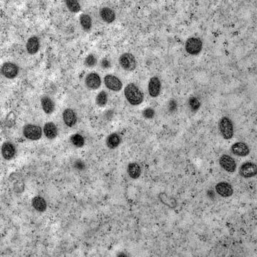 monkeypox_02 Brasil registra 55 casos de mpox em 2026 e acende alerta para nova variante identificada no exterior