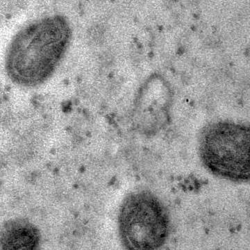 monkeypox_03 Brasil registra 88 casos de mpox em 2026, com maioria em São Paulo