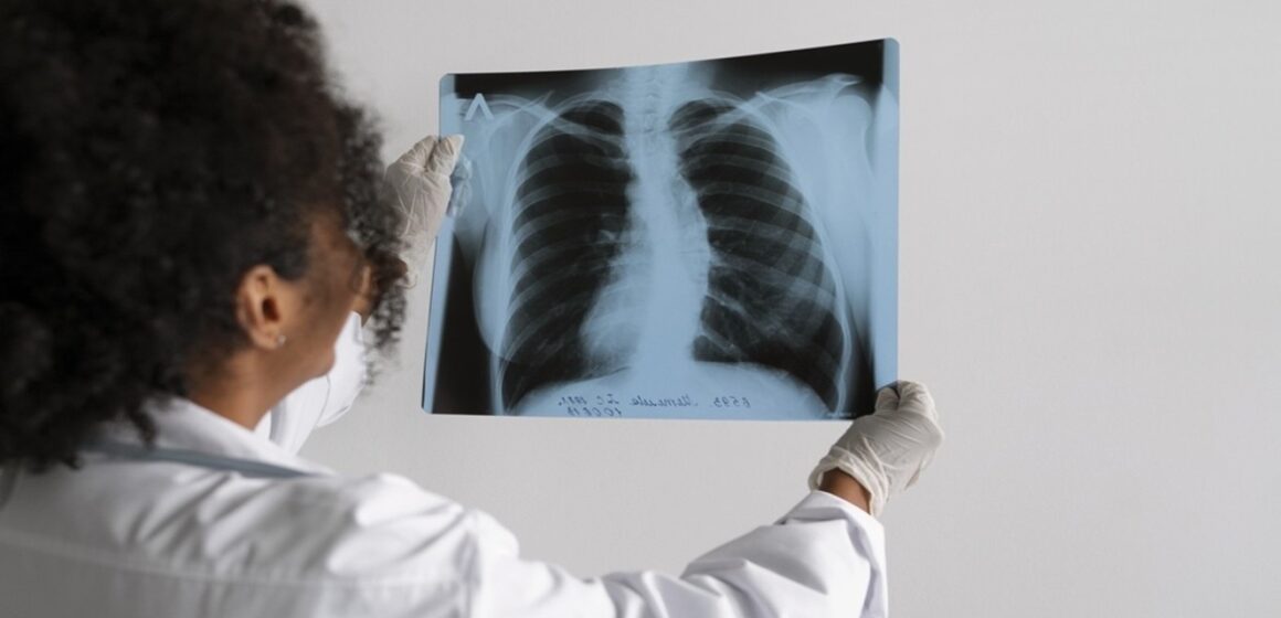 Santarém registra queda de 20,5% nos casos de tuberculose no primeiro trimestre de 2026