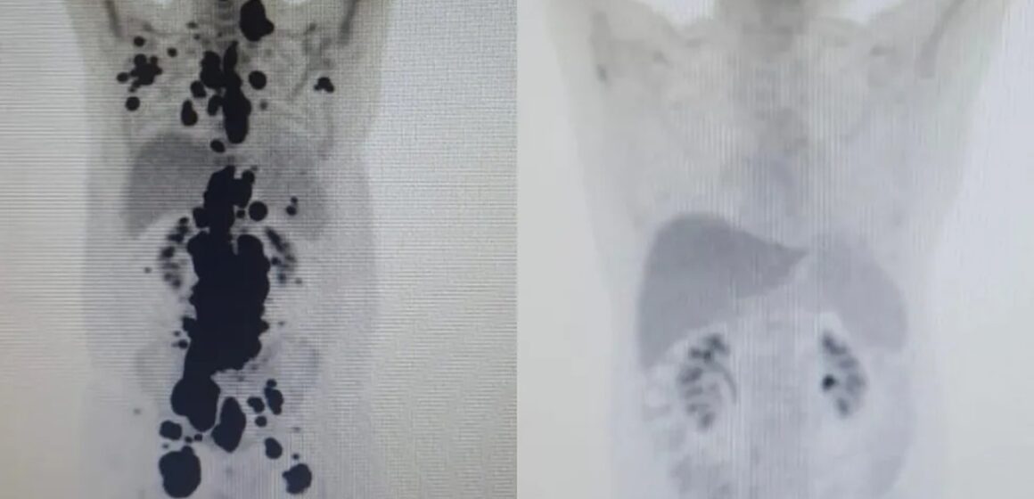 1684434403504689 Terapia inovadora desenvolvida pela USP apresenta resposta positiva em 87,5% dos pacientes com linfoma