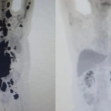 1684434403504689 Terapia inovadora desenvolvida pela USP apresenta resposta positiva em 87,5% dos pacientes com linfoma