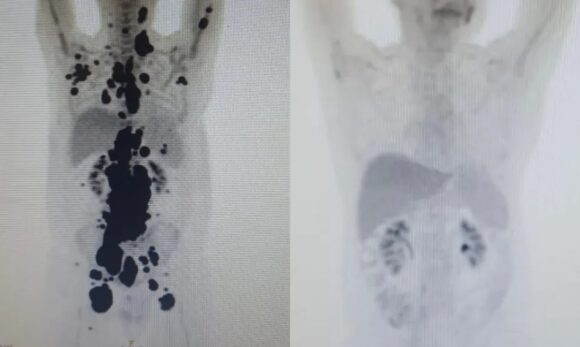 1684434403504689 Terapia inovadora desenvolvida pela USP apresenta resposta positiva em 87,5% dos pacientes com linfoma