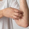 Verão exige cuidados contra alergias; dermatologista orienta sobre prevenção e sinais de alerta