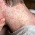 Sarampo: sintomas incluem manchas vermelhas e febre alta; vacinação é a principal forma de prevenção