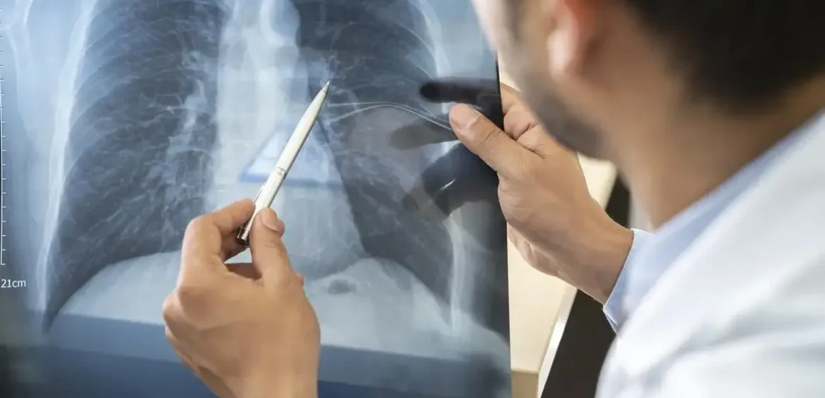 estagios-cancer-de-pulmao Tabagismo é maior entre jovens de 16 a 24 anos, com 19% de fumantes ativos, acima da média nacional de 17%
