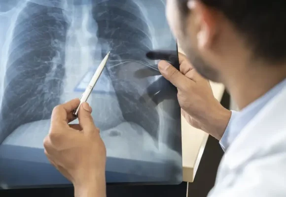 estagios-cancer-de-pulmao Tabagismo é maior entre jovens de 16 a 24 anos, com 19% de fumantes ativos, acima da média nacional de 17%
