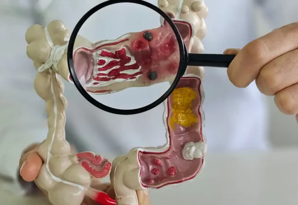 Em 13 anos, doença inflamatória intestinal cresce 5 vezes no Brasil