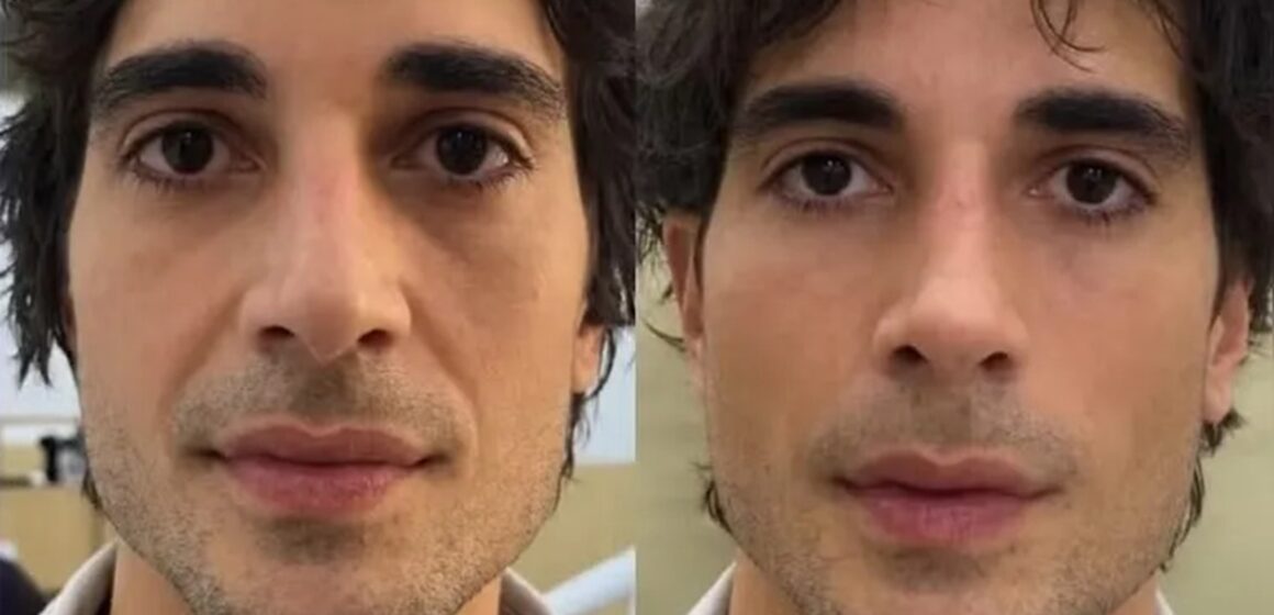 Fiuk aparece com novo visual após procedimento de harmonização facial